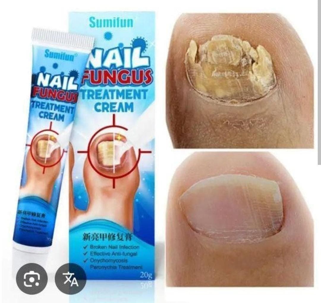 Nail fangae treatment cream